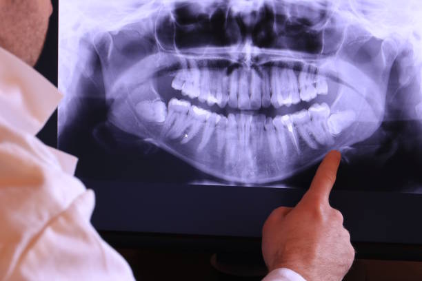 Best Emergency Dentist for Lost Fillings or Crowns in Beacon, NY